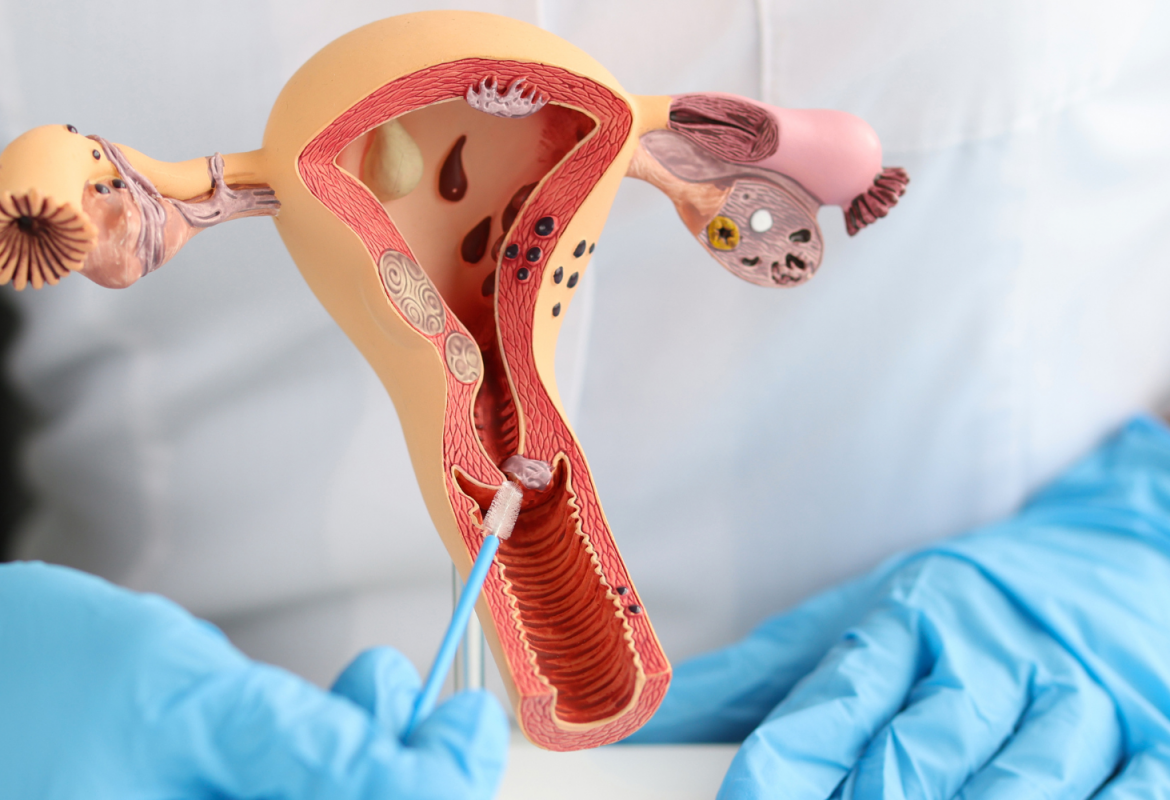 Pólipos endometriais na prática do ginecologista